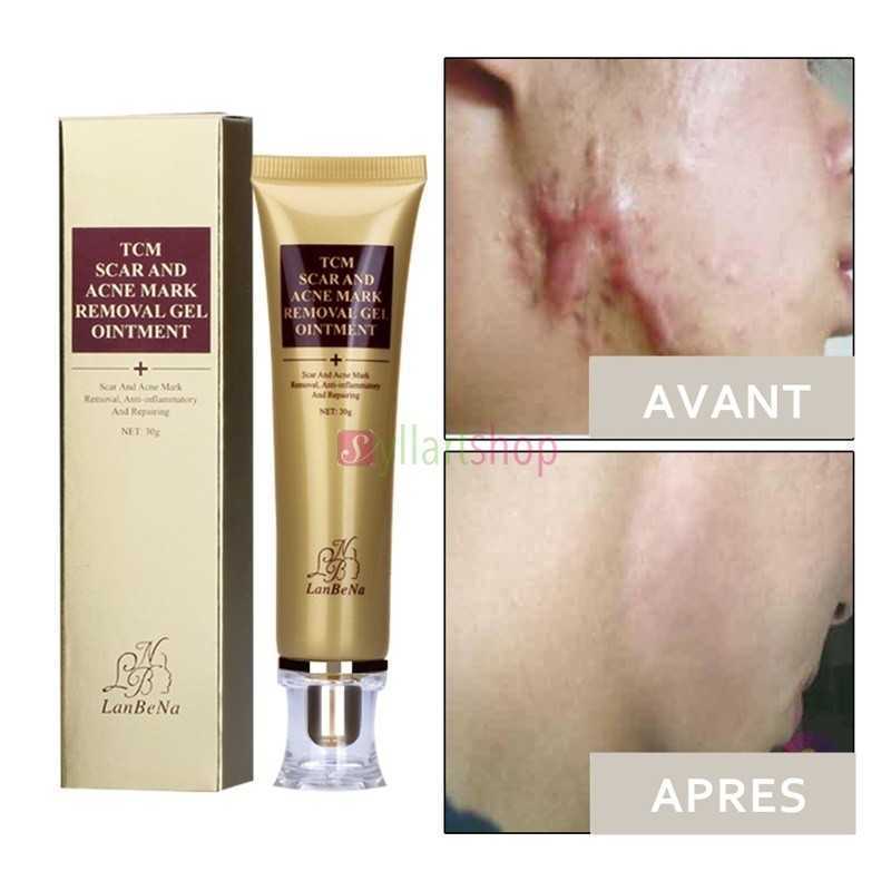 Gel d'élimination des cicatrices et des marques d'acné LANBENA LB6221 Gel d'élimination des cicatrices et des marques d'acné LANBENA LB6221