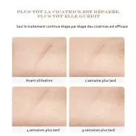 Gel d'élimination des cicatrices et des marques d'acné LANBENA LB6221